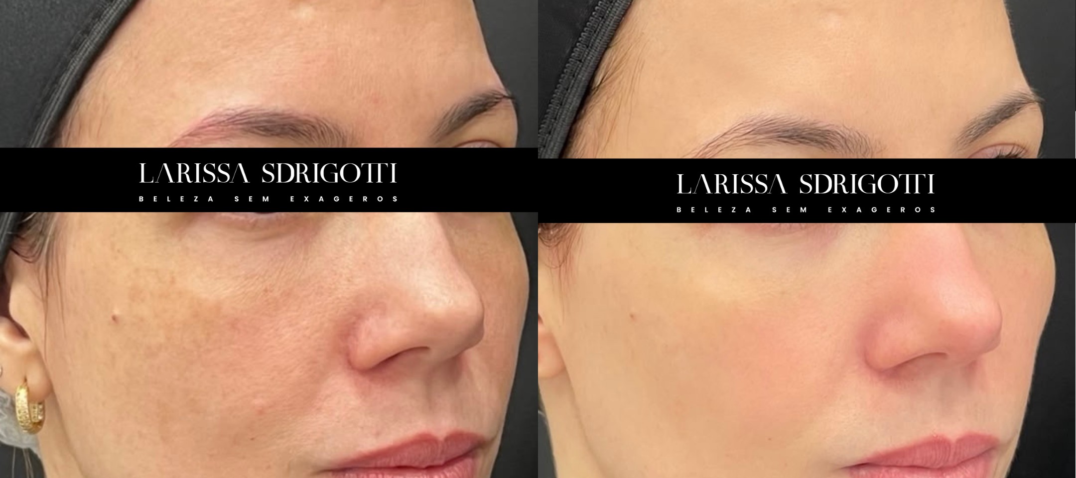 Antes e depois do tratamento com Red Touch, paciente 1