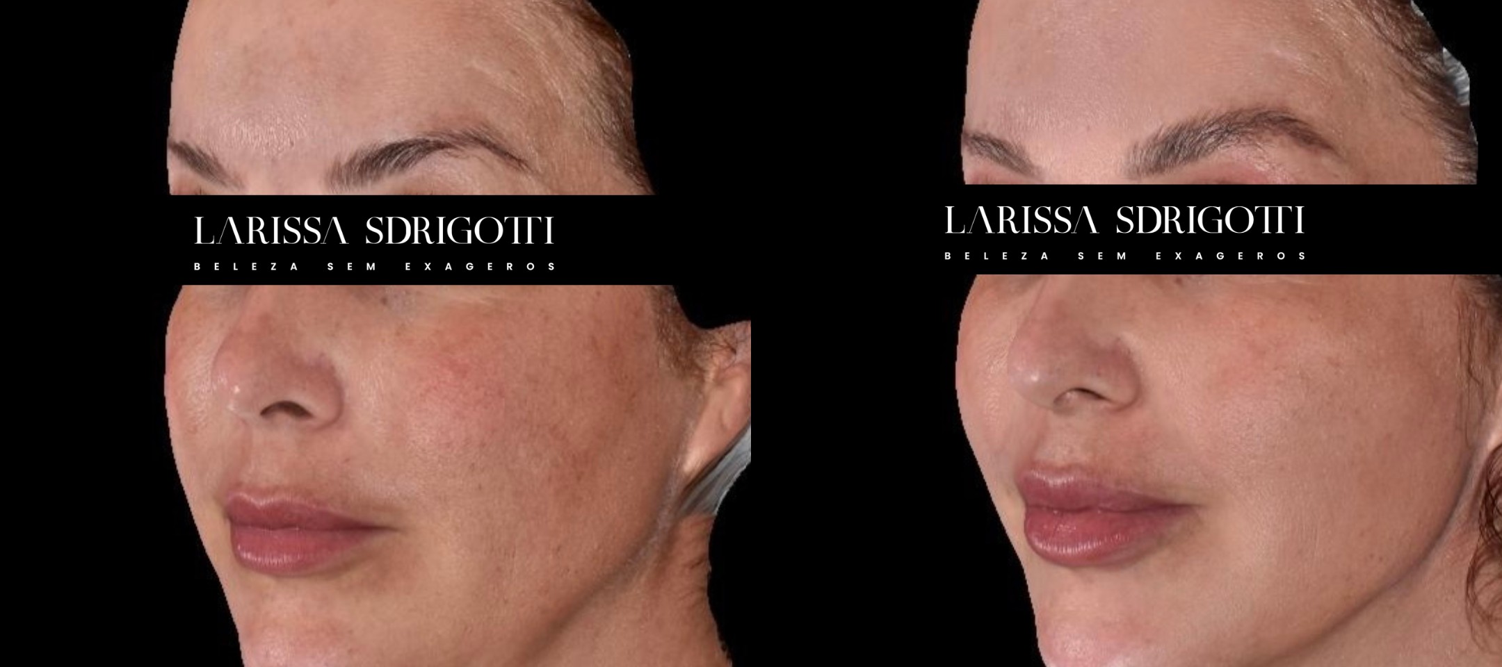 Antes e depois do tratamento com Red Touch, paciente 2
